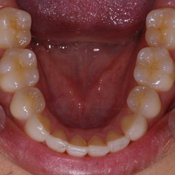 Christopher S. Aufdemberg , DDS - After - General Dentistry Near Me - Tustin, California Christopher S. Aufdemberg , DDS - After - General Dentistry Near Me - Tustin, California