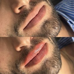 Refresh Med Spa - my before and after results!