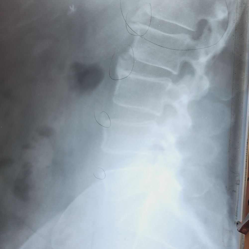 Lynch Chiropractic Center - Curve and bulging disks. - Chiropractors Near Me - Lexington, Kentucky Lynch Chiropractic Center - Curve and bulging disks. - Chiropractors Near Me - Lexington, Kentucky