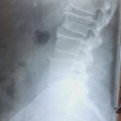 Lynch Chiropractic Center - Curve and bulging disks.