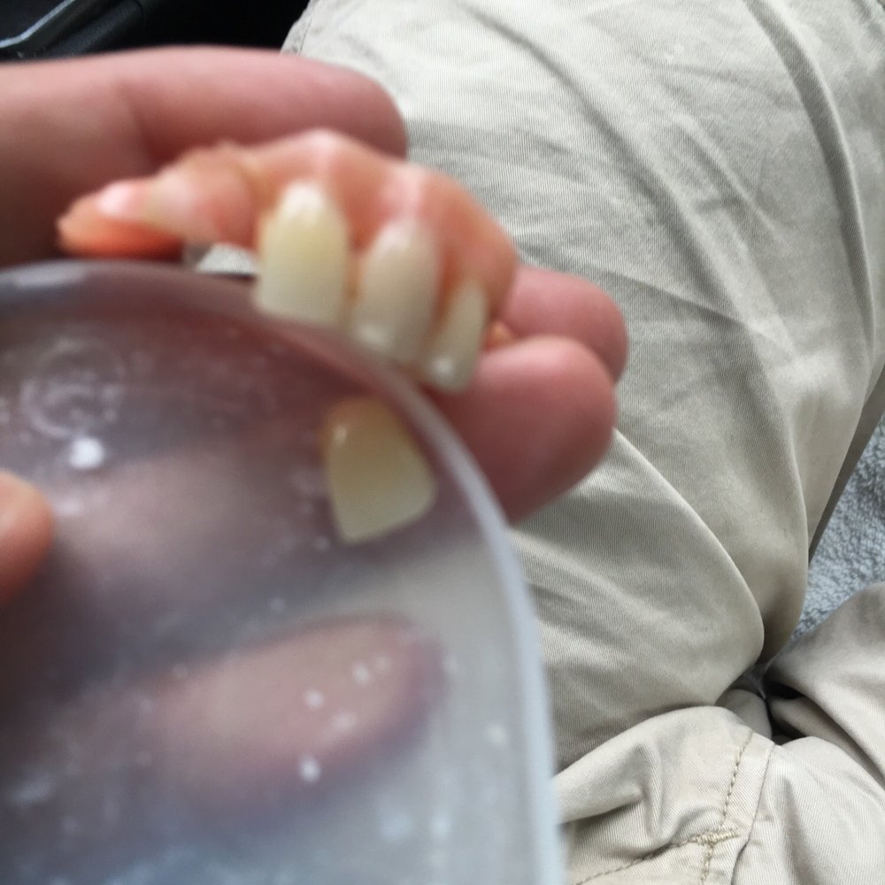 First Care Dental Center - One of the tooth just fell off with no impact or hard chewing - Dentists Near Me - Parsippany, New Jersey First Care Dental Center - One of the tooth just fell off with no impact or hard chewing - Dentists Near Me - Parsippany, New Jersey