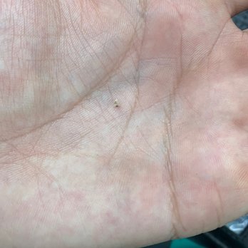 Daniela Dental - Piece of extracted tooth that came from my stitching being loose - Cosmetic Dentists Near Me - San Antonio, Texas