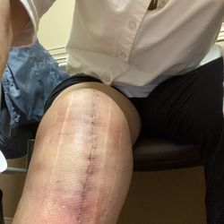 Physical Therapy In Motion - Total knee replacement cared for by Chad Uffelman and Jaylynn
