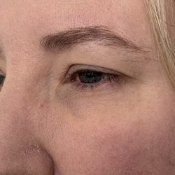Piedmont Plastic Surgery & Dermatology - Non lazy eye- injected mire to " match" lazy eye. Vision affected
