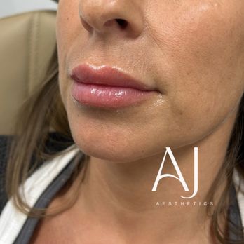Anne Judge Aesthetics - Lip filler - Medical Spas Near Me - Brigantine, New Jersey Anne Judge Aesthetics - Lip filler - Medical Spas Near Me - Brigantine, New Jersey