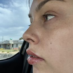 Side profile 2 weeks after procedure