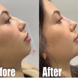 South Florida Face and Body - Chin filler