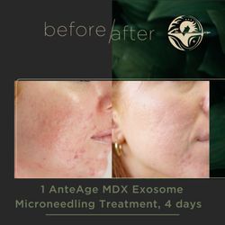 Artemis22 Beauty Club Medspa - SkinPen Microneedling with AnteAge Exosomes