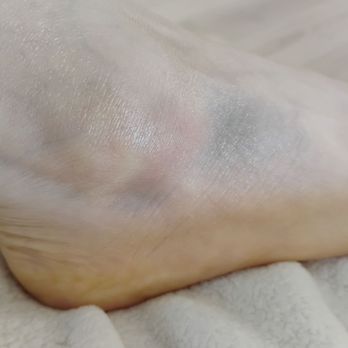 Peggy Lee Skin Care - Bruising around my ankle after impact with her small metal cot for facials. Insane that this happened. - Skin Care Near Me - Berkeley, California Peggy Lee Skin Care - Bruising around my ankle after impact with her small metal cot for facials. Insane that this happened. - Skin Care Near Me - Berkeley, California