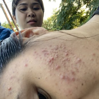 Acne Solutions Skin Care & Spa - Acne Treatment Near Me - Upland, California