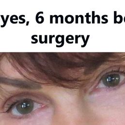 Malcolm D Paul, MD - My eyes BEFORE surgery - Plastic Surgeons Near Me - Las Vegas, Nevada