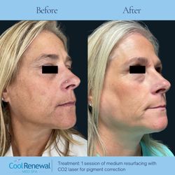 Cool Renewal Spa - Before and After Skin resurfacing.