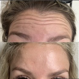 Top- Before; Bottom- 8 days post- injection