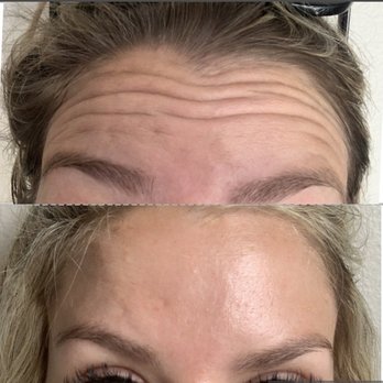 NeoMed - Top- Before; Bottom- 8 days post- injection - Skin Care Near Me - Temecula, California