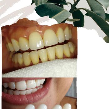 Glow Devotion Studio - Teeth Whitening Client - Teeth Whitening Near Me - Lake Jackson, Texas