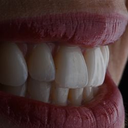 Healthy Smiles Dental - Porcelain Veneers