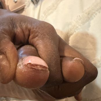 Ooh La La Nail Bar - Thick acrylic causing ingrown toe nail. - Nail Salons Near Me - Richardson, Texas