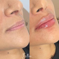 Bellina Medical Aesthetics - 1ml of Restylane Kysse