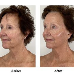 Premiere Aesthetics - Before and after PRX non invasive skin tightening treatment.