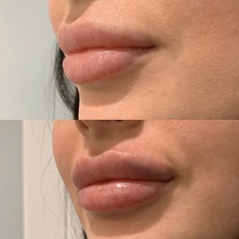 Meesha Aesthetics - Lip filler before/after - Medical Spas Near Me - Allentown, Pennsylvania Meesha Aesthetics - Lip filler before/after - Medical Spas Near Me - Allentown, Pennsylvania