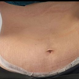 2 Weeks Post OP 2 Weeks Post OP