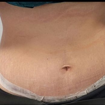 Lotus Clinical Research - 2 Weeks Post OP - Medical Centers Near Me - Pasadena, California Lotus Clinical Research - 2 Weeks Post OP - Medical Centers Near Me - Pasadena, California