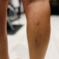 Nail Kingdom - Bruises from digging her nails into me during massage