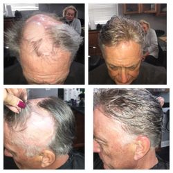 Hair Solutions of Tampa - Medical procedure hair loss client with our exclusive solution