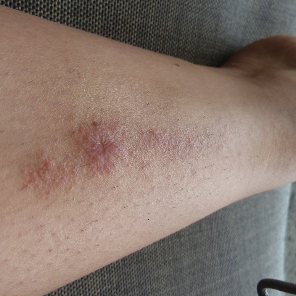 David J Kaplan, DPM - this is the BURN that Dr Kaplan left on my left on my leg with his attempt at laser hair removal!! i have a horrible scar now - Podiatrists Near Me - San Mateo, California David J Kaplan, DPM - this is the BURN that Dr Kaplan left on my left on my leg with his attempt at laser hair removal!! i have a horrible scar now - Podiatrists Near Me - San Mateo, California