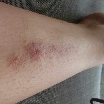 David J Kaplan, DPM - this is the BURN that Dr Kaplan left on my left on my leg with his attempt at laser hair removal!!  i have a horrible scar now - Podiatrists Near Me - San Mateo, California