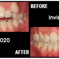 Cherubini Orthodontics - Invisalign Correction of Severe Crowding with an Open Bite