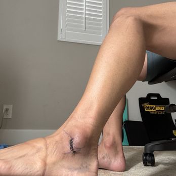Robert Joseph, DPM - 4 weeks post surgery - Podiatrists Near Me - Beverly Hills, California Robert Joseph, DPM - 4 weeks post surgery - Podiatrists Near Me - Beverly Hills, California