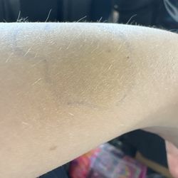 Cedar Springs BHS Hospital - A bruise one of the staff gave while restraining me for trying to push a kid off me while she was trying to hurt me.