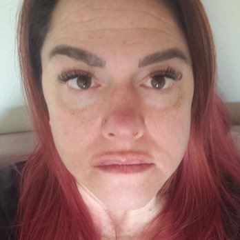 Sikara Medspa - Immediately after first treatment (lips enlarged & fixed cupids bow, under eyes, laugh lines & Dysport. - Skin Care Near Me - Las Vegas, Nevada Sikara Medspa - Immediately after first treatment (lips enlarged & fixed cupids bow, under eyes, laugh lines & Dysport. - Skin Care Near Me - Las Vegas, Nevada