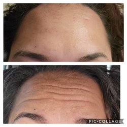 Lotus Luxe Med Spa - Botox before and after