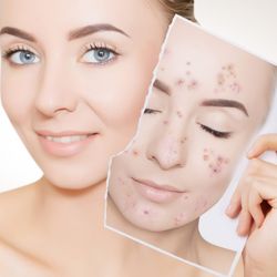 European Skincare & Acne Clinic - Acne Treatment European Skincare and Spa