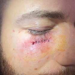 Exer Urgent Care - Porter Ranch - Picture taken immediately after stitches were finished