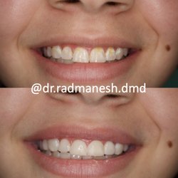 Harmony Dental Care - Santa Clarita - Smile Transformation