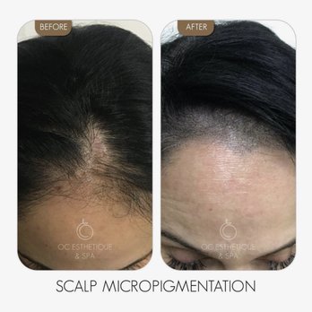 OC Esthetique and Spa - Scalp Micropigmentation - Skin Care Near Me - Anaheim, California OC Esthetique and Spa - Scalp Micropigmentation - Skin Care Near Me - Anaheim, California