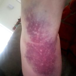 1 cm x 1 cm mass in upper arm due to phlebotomist entering an artery rather than a vein. 1 cm x 1 cm mass in upper arm due to phlebotomist entering an artery rather than a vein.