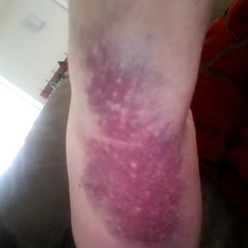 American Red Cross - 1 cm x 1 cm mass in upper arm due to phlebotomist entering an artery rather than a vein. - CPR Classes Near Me - Albany, New York American Red Cross - 1 cm x 1 cm mass in upper arm due to phlebotomist entering an artery rather than a vein. - CPR Classes Near Me - Albany, New York