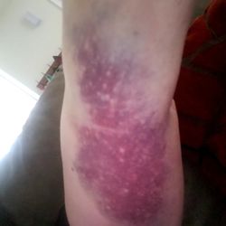 American Red Cross - 1 cm x 1 cm mass in upper arm due to phlebotomist entering an artery rather than a vein.