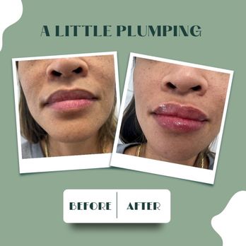 Full Circle Care - Before and After Juvederm Lip Filler - Medical Spas Near Me - Las Vegas, Nevada Full Circle Care - Before and After Juvederm Lip Filler - Medical Spas Near Me - Las Vegas, Nevada