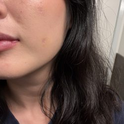 South Coast MedSpa - After the 8th profractional laser treatment with prp and subcision (with makeup).