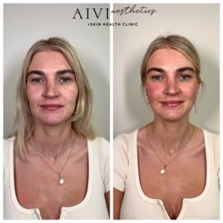 AIVI Aesthetics - Mid Face PDO Threads