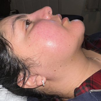 Lorena’s Healing Essence - After lymphatic drainage - Body Contouring Near Me - Redwood City, California Lorena’s Healing Essence - After lymphatic drainage - Body Contouring Near Me - Redwood City, California