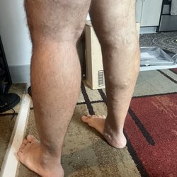 USA Vein Clinics - Both legs after six or seven weeks