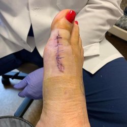 Jeremy Evans, DPM - Eight days after surgery!