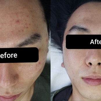 For Me Skin Care - Acne Treatment + One-Day Peeling - Skin Care Near Me - Buena Park, California For Me Skin Care - Acne Treatment + One-Day Peeling - Skin Care Near Me - Buena Park, California