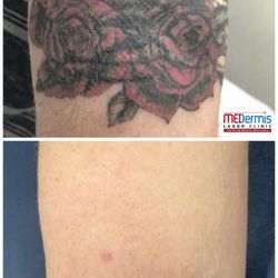 MEDermis Tattoo Removal  - 12 treatments